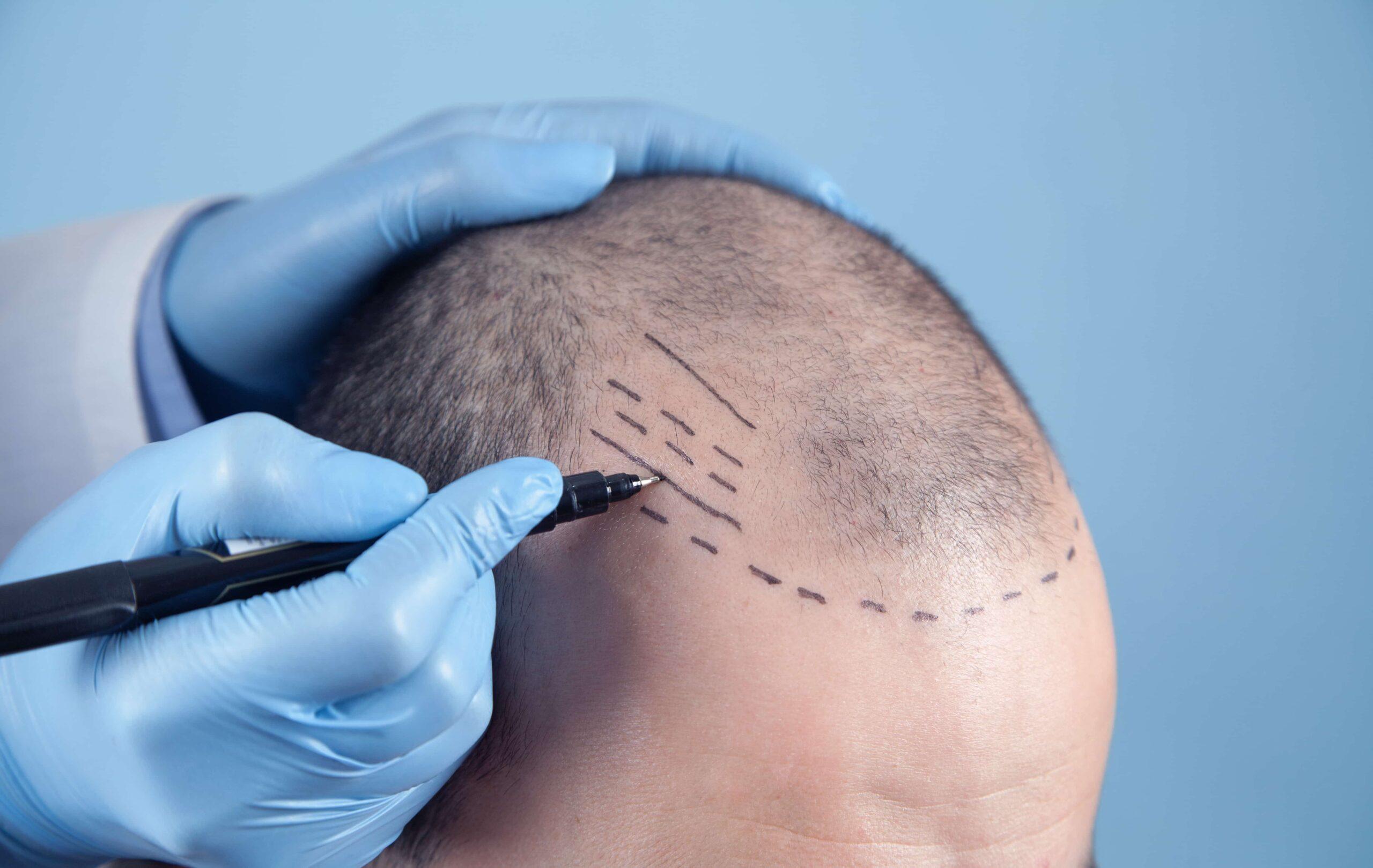 DHI Hair Transplant